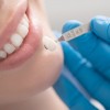 Răng sậm màu và các biện pháp cải thiện (nha khoa quận 11)