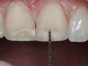 phương pháp xử lý tình trạng răng hô nhẹ phổ biến nhất hiện nay